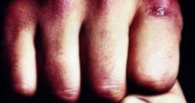 Užas u novogodišnjoj noći: U Sarajevu pretučen njemački državljanin