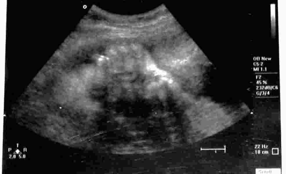 Prije abortusa žene će morati da slušaju kucanje srca svoga fetusa