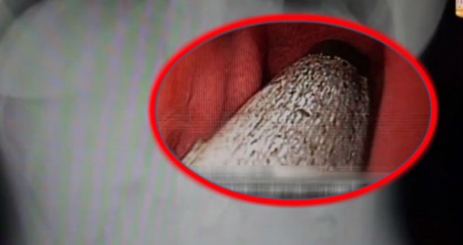 Šokirat će vas što su joj ljekari pronašli u želucu nakon 6 mjeseci bolova 