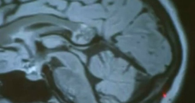 Medicinsko čudo: Mislila je da ima tumor, ali joj je u glavi rastao blizanac!!