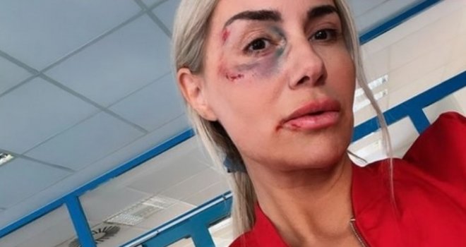 Lice joj u modricama, oko očiju podlivi, na usni posjekotina: Nova fotografija Selme Bajrami sve šokirala
